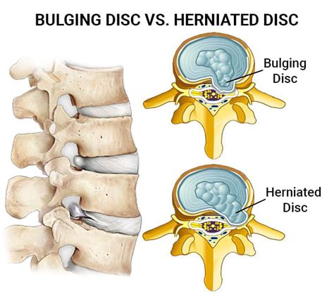 slippedisc|bulging disc.